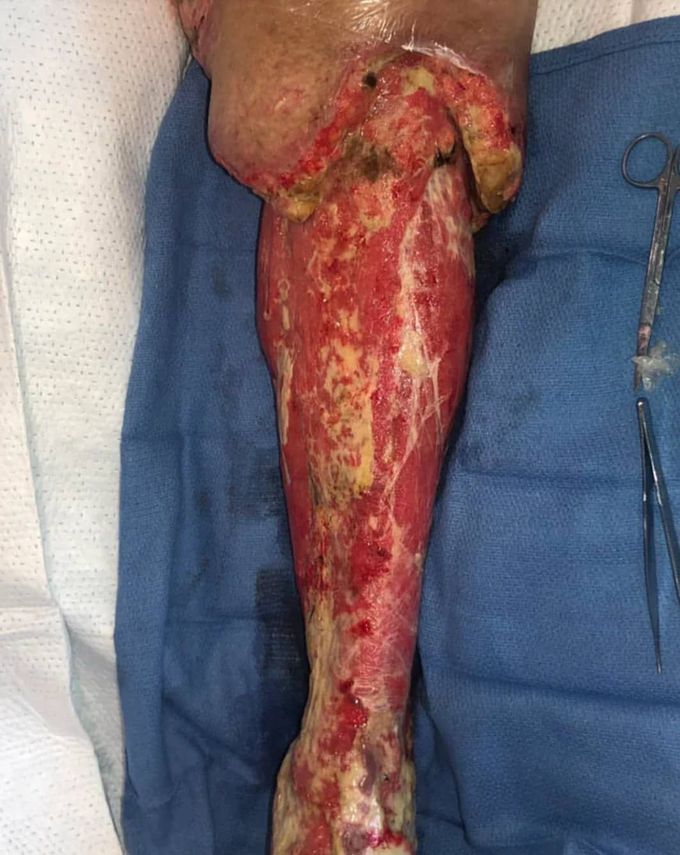 Case of necrotizing fasciitis of the leg, post debridement. 