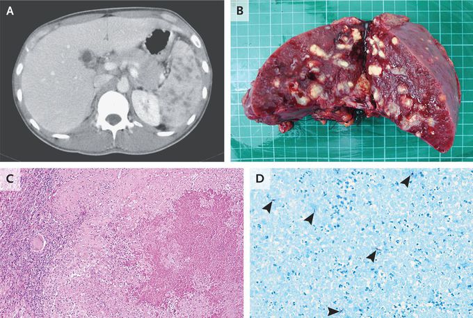 Splenic Tuberculosis