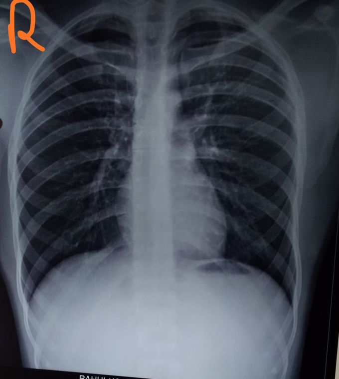 Chest- x ray