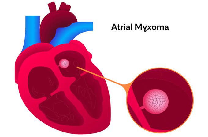 Causes of myxoma