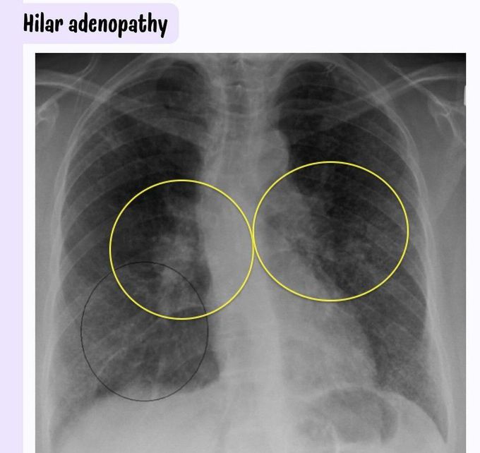 Sarcoidosis Radiology