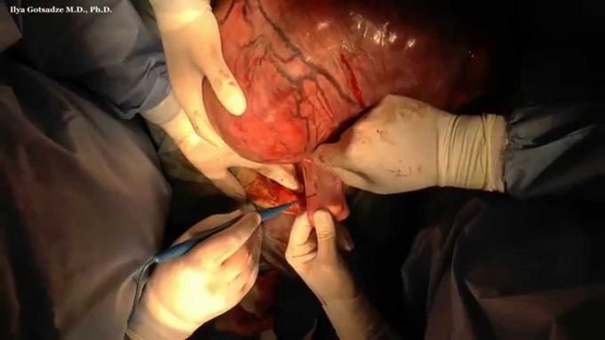 Surgery of Giant  Leiomyosarcoma of the Uterus