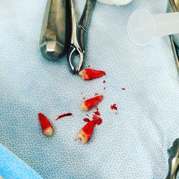 Premolar extractions