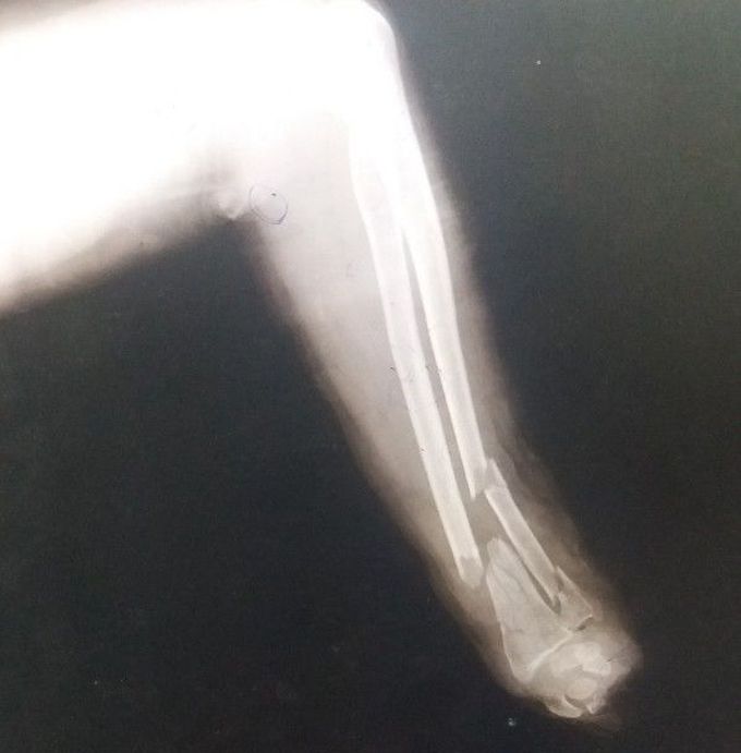 Toka machine (fodder cutter  ) injury