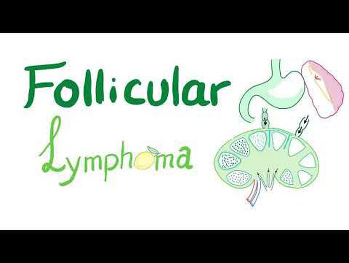 Follicular lymphoma