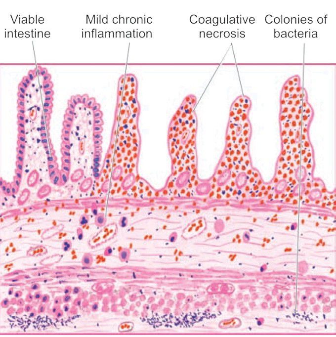 Wet gangrene of the small bowel.