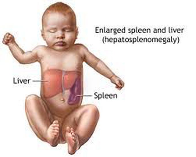 Hepatosplenomegaly