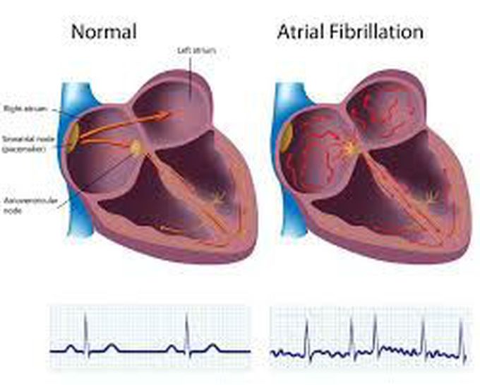 Causes of atrial fibrillation