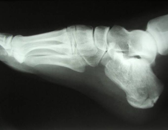 Osteopenia