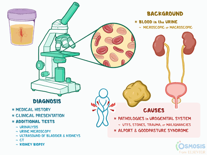 Symptoms of hematuria