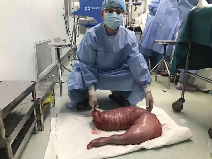 Hirschsprung Diseashie: Surgeon Removes 13 kgs Of Man’s Constipated Colon