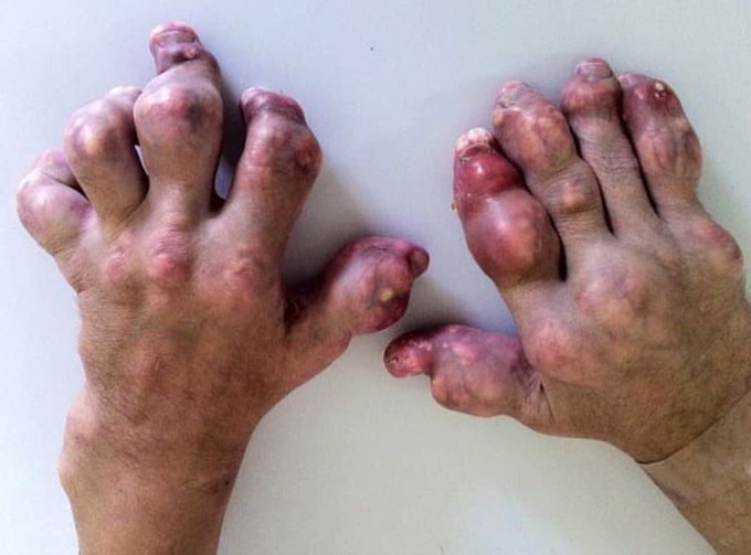 Numerous large tophi with associated joint deformity in the hands of a young patient