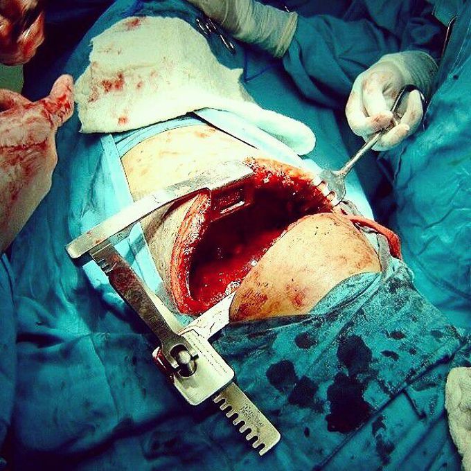 Anterolateral thoracotomy
