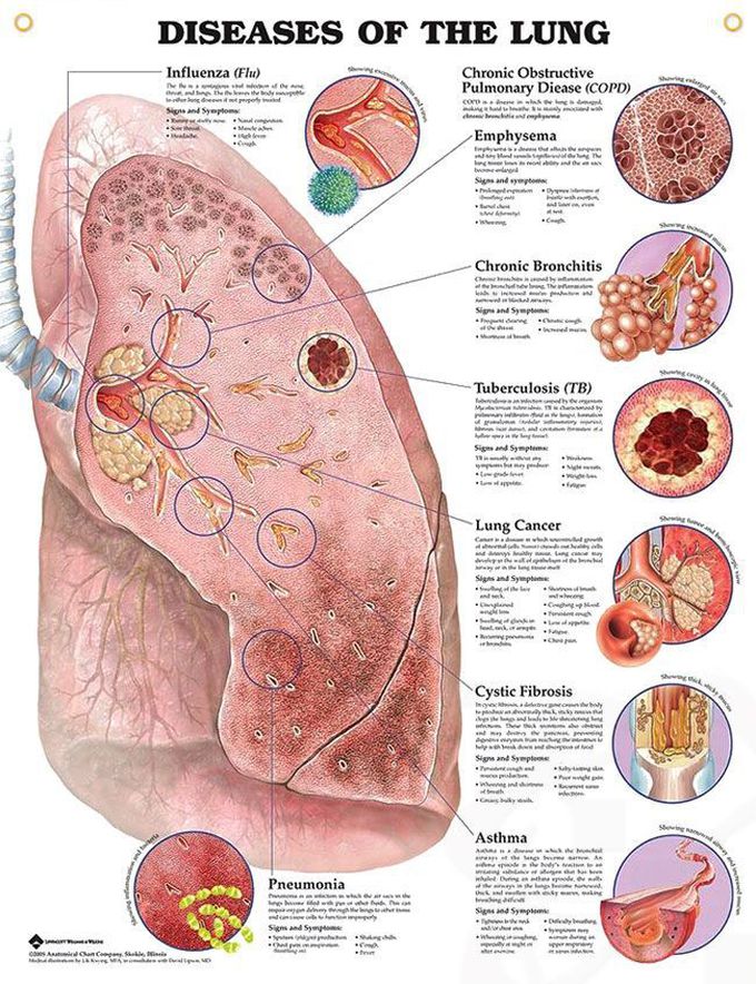 Diseases of the Lung anatomy poster