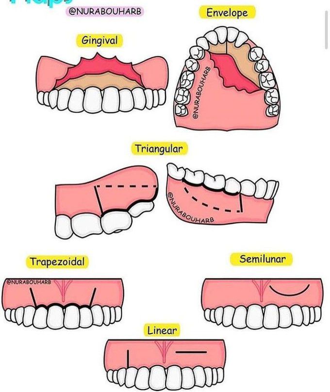 Types of flaps in oral surgery