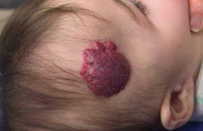 Cavernous Hemangioma