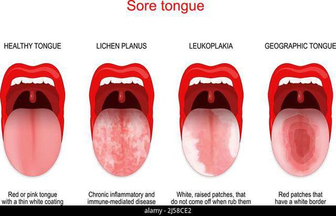 Sore tongue