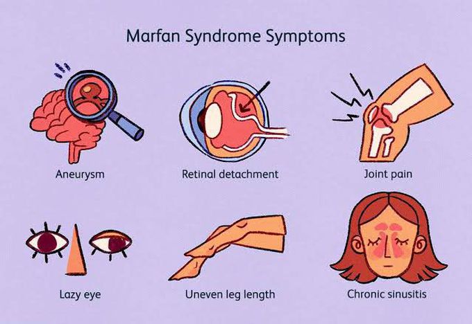 These are the symptoms of Marfan syndrome