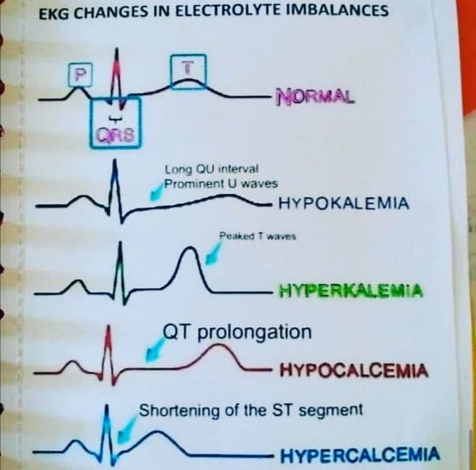 ECG changes in electrolyte imbalances