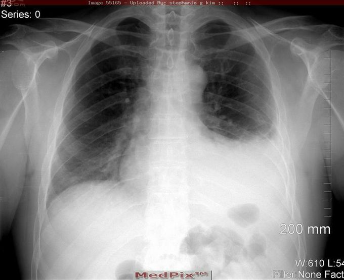 Hemothorax❤