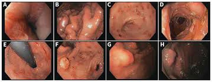 Zollinger-Ellison Syndrome