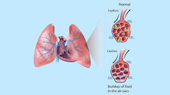 Symptoms of pulmonary edema