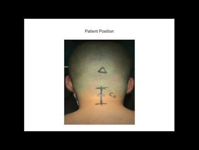 A midline post. approach for treatment of os odontoideum via atlantoaxial reduction, bone graft ...