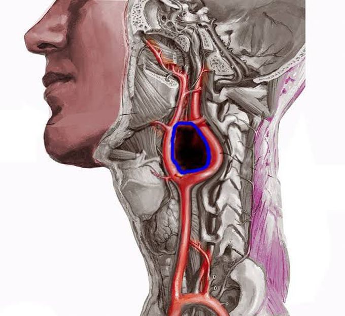 Chemodectoma