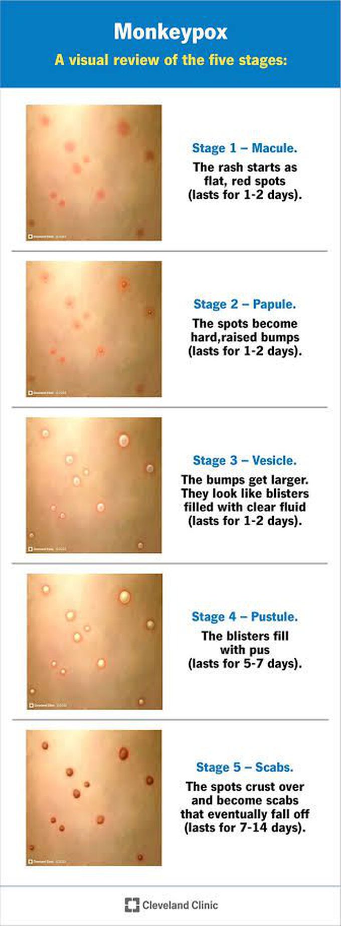 Monkeypox