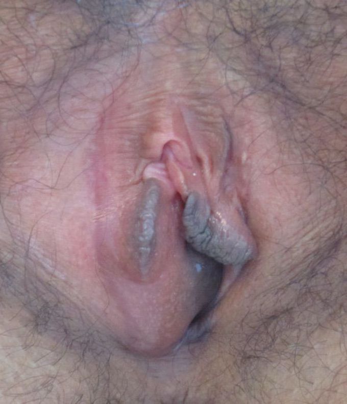 Bartholin's cyst