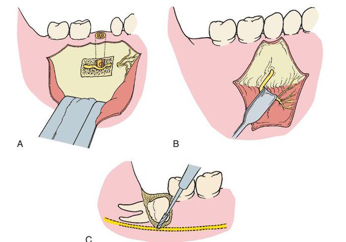 Three types of peripheral nerve injury.