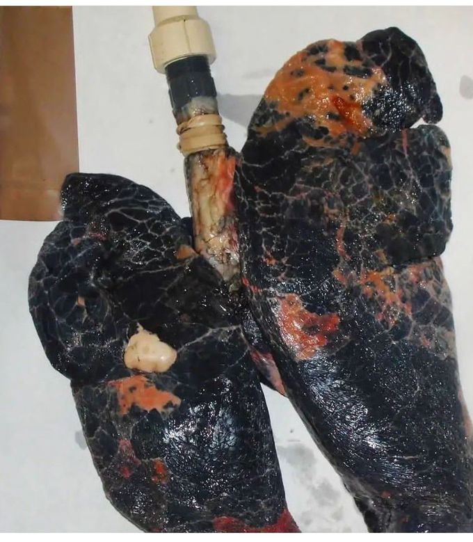 Smoker Lungs