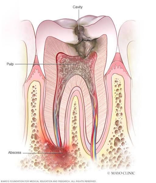 Tooth abscess - MEDizzy
