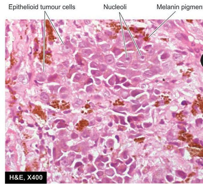 Uveal melanoma