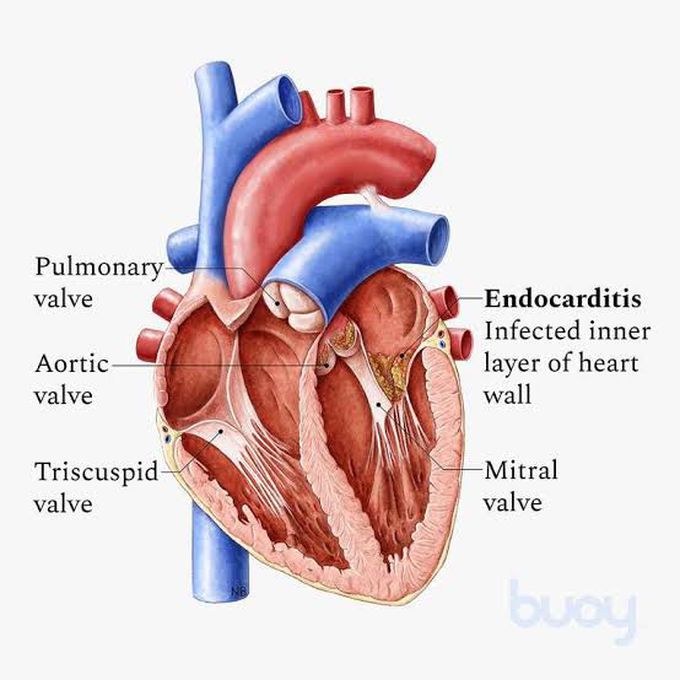 Endocarditis
