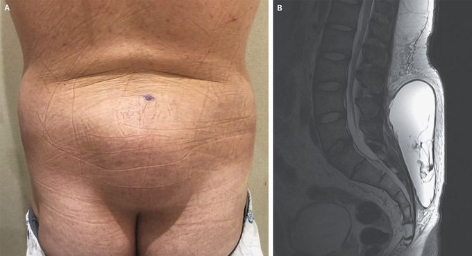 Morel–Lavallée Lesion