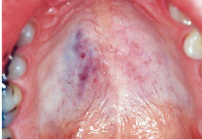 Vascular malformation of palate