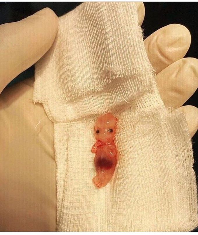 9-week-old Fetus