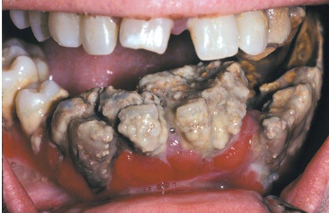 Chronic Gingivitis