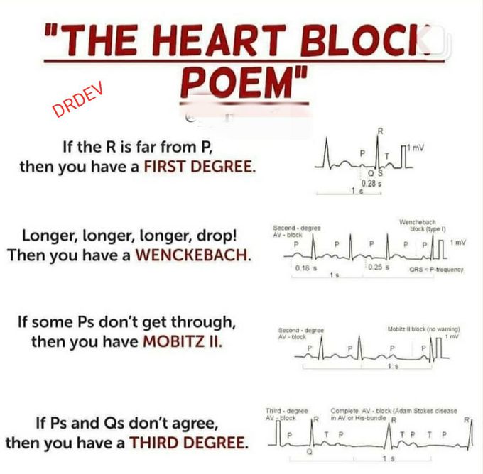 Heart block