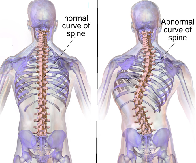 Idiopathic scoliosis