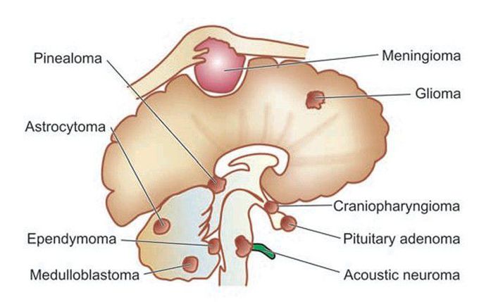 Intracranial tumours