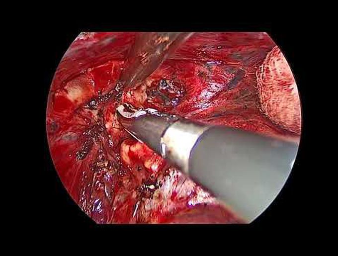Uniportal VATS Anatomic Right Basal Segmentectomy (S7-10)