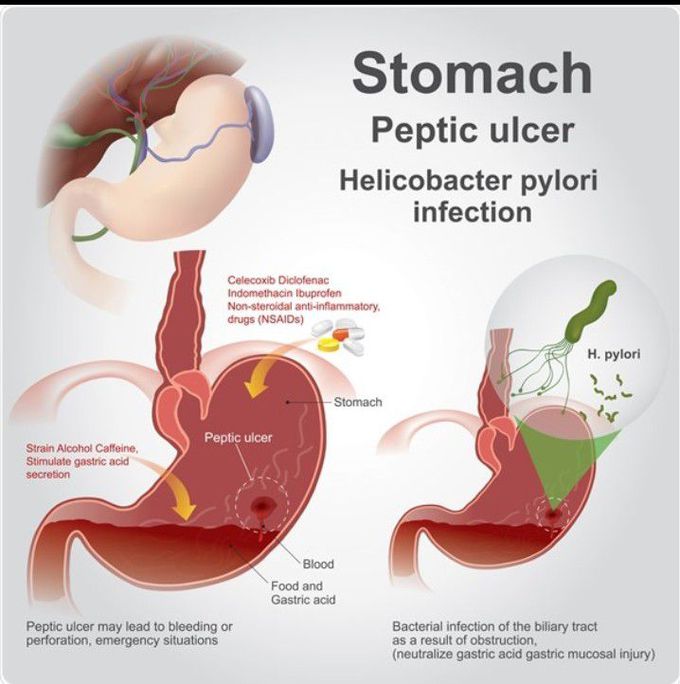 Peptic Ulcer