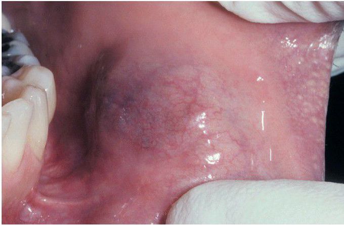 Mammary Analogue Secretory Carcinoma