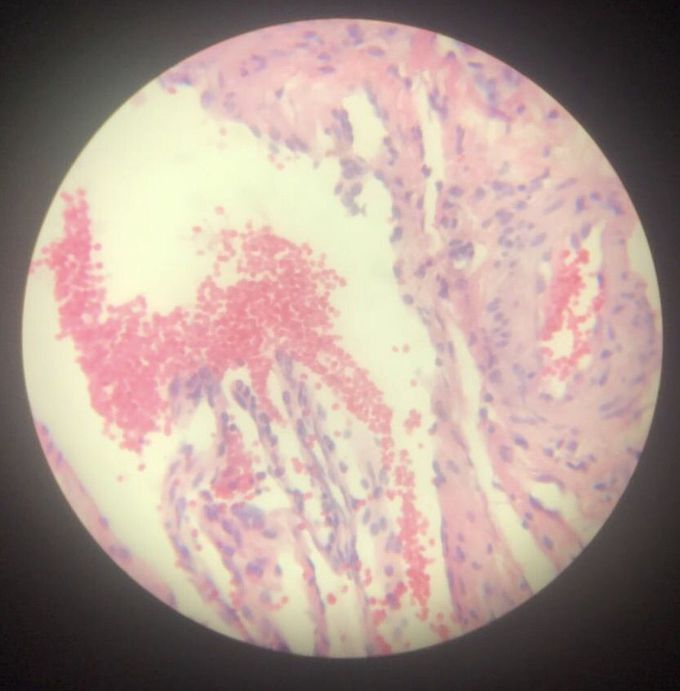Kaposi Sarcoma