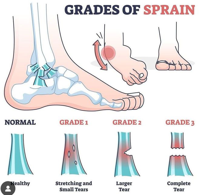 Grades of Sprain