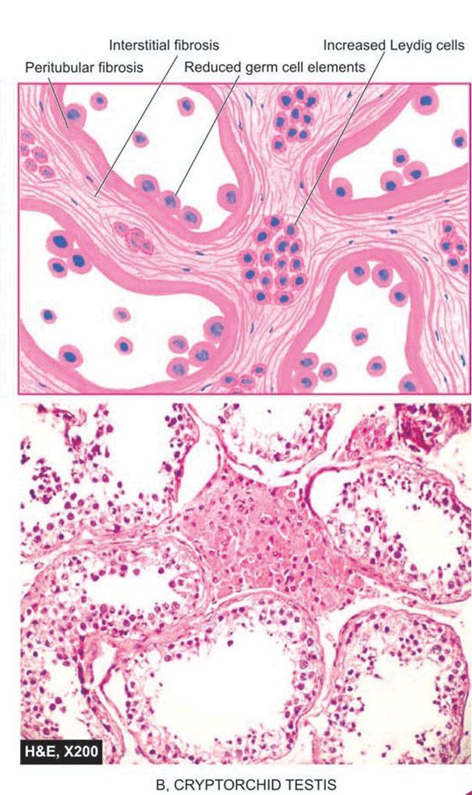 Cryporchid testis