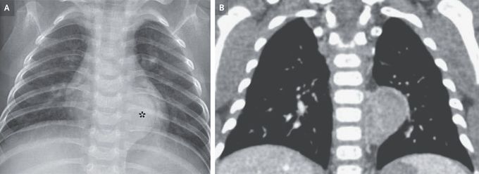 Incidental Neuroblastoma