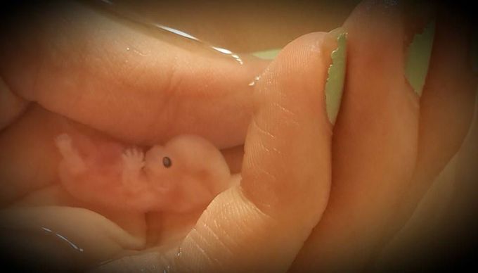 Annabelle was 8 weeks, 5 days old when her mother had a miscarriage and took this photo of her.